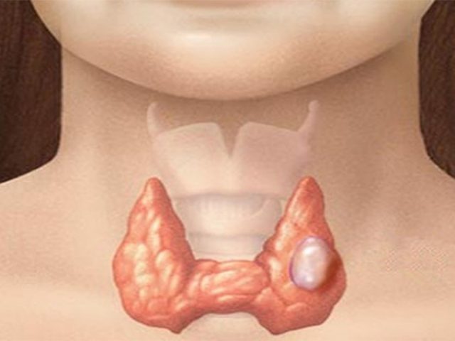 Cada dos horas se diagnostica un nuevo caso de cáncer de tiroides en Argentina